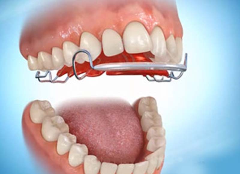 Orthodontic Appliances